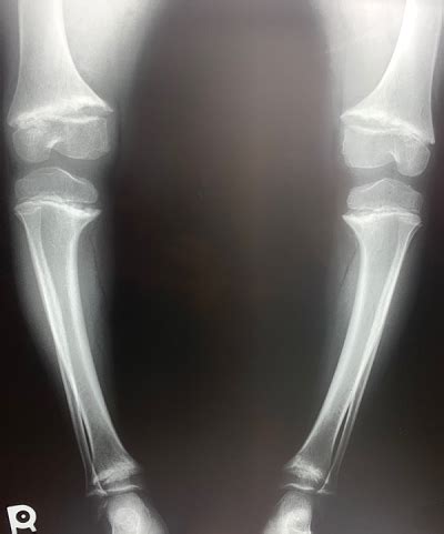 metaphyseal chondrodysplasia pena.